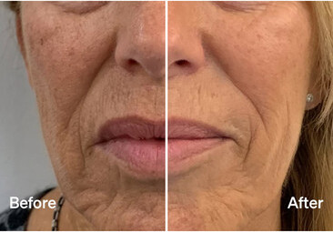 LYMA Laser Mist & Glide Refill 60 Days